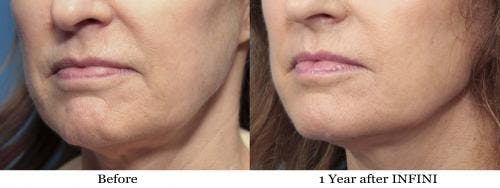 Infini Before & After Gallery - Patient 58214294 - Image 3