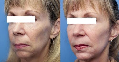 Laser Treatments Before & After Gallery - Patient 58214295 - Image 3