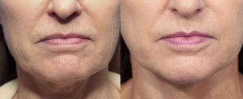 Infini Before & After Gallery - Patient 58214296 - Image 2