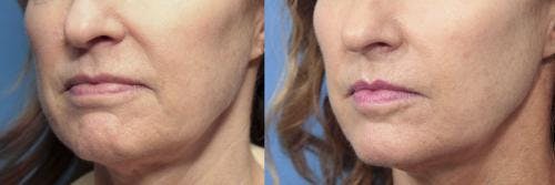Infini Before & After Gallery - Patient 58214296 - Image 3