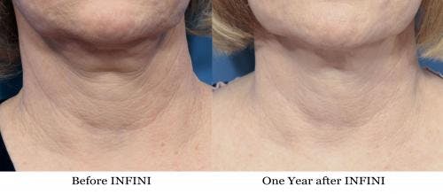 Infini Before & After Gallery - Patient 58214297 - Image 1