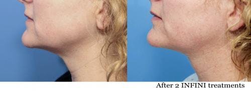 Infini Before & After Gallery - Patient 58214298 - Image 1