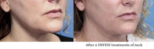 Infini Before & After Gallery - Patient 58214298 - Image 2