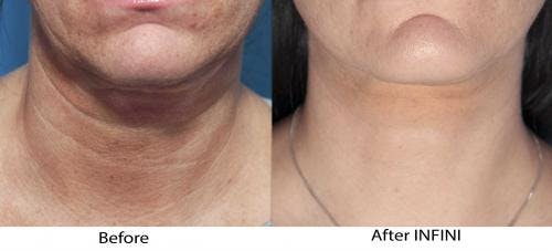 Infini Before & After Gallery - Patient 58214299 - Image 1