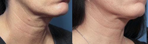 Infini Before & After Gallery - Patient 58214299 - Image 2