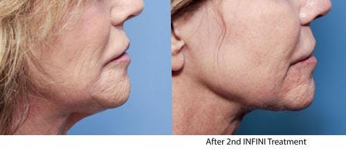 Infini Before & After Gallery - Patient 58214300 - Image 1