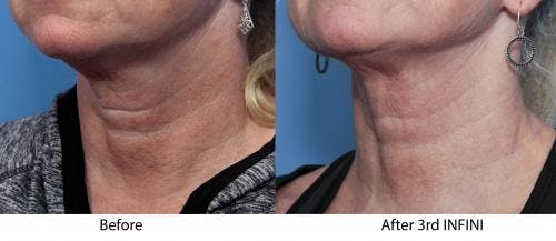 Infini Before & After Gallery - Patient 58214302 - Image 1