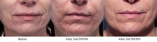 Infini Before & After Gallery - Patient 58214303 - Image 2