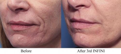 Infini Before & After Gallery - Patient 58214303 - Image 3