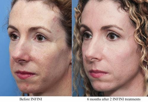 Infini Before & After Gallery - Patient 58214304 - Image 1