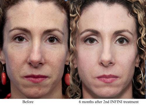 Infini Before & After Gallery - Patient 58214304 - Image 2
