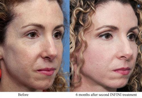 Infini Before & After Gallery - Patient 58214304 - Image 3