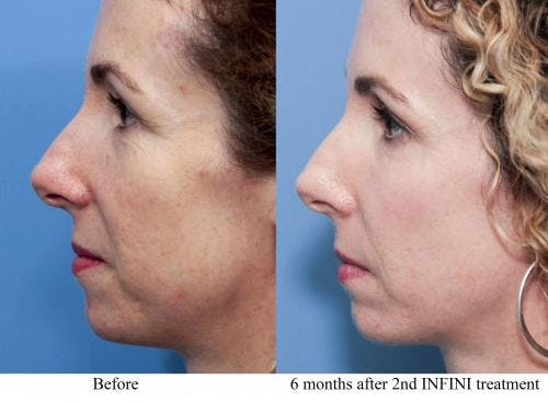 Infini Before & After Gallery - Patient 58214304 - Image 4
