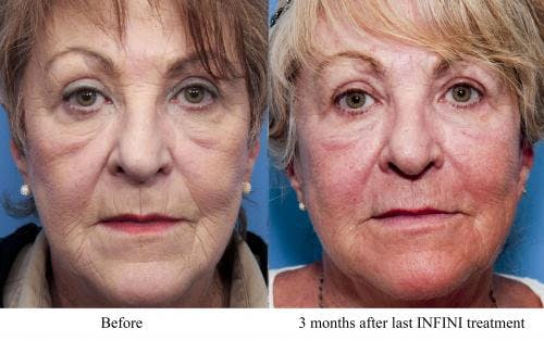 Infini Before & After Gallery - Patient 58214306 - Image 2