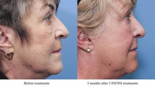 Infini Before & After Gallery - Patient 58214306 - Image 3