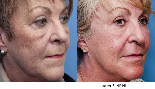 Infini Before & After Gallery - Patient 58214306 - Image 5