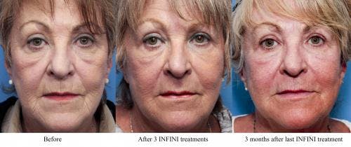 Infini Before & After Gallery - Patient 58214306 - Image 6
