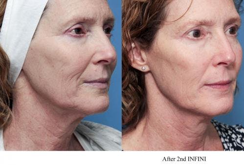 Infini Before & After Gallery - Patient 58214308 - Image 1