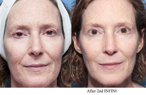 Infini Before & After Gallery - Patient 58214308 - Image 2