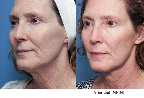 Infini Before & After Gallery - Patient 58214308 - Image 3