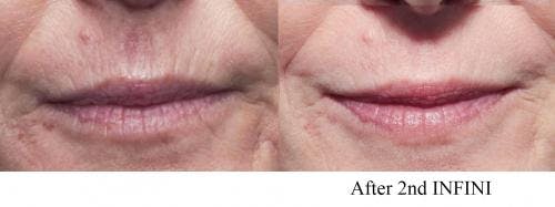 Infini Before & After Gallery - Patient 58214308 - Image 4