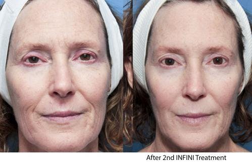 Infini Before & After Gallery - Patient 58214308 - Image 5
