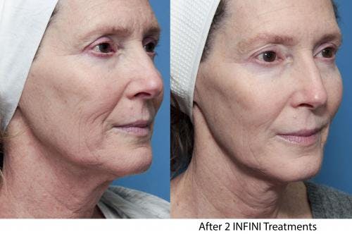 Infini Before & After Gallery - Patient 58214308 - Image 6