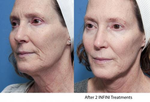 Infini Before & After Gallery - Patient 58214308 - Image 7