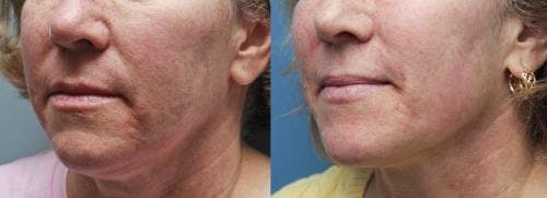Infini Before & After Gallery - Patient 58214309 - Image 1