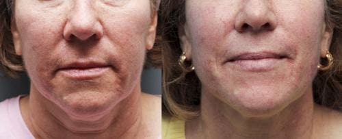Infini Before & After Gallery - Patient 58214309 - Image 2