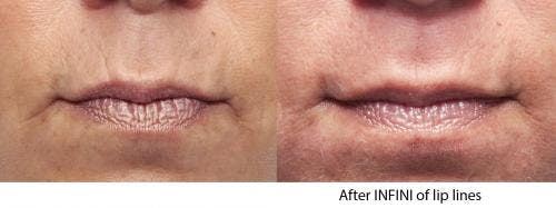 Infini Before & After Gallery - Patient 58214310 - Image 2