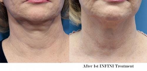 Infini Before & After Gallery - Patient 58214311 - Image 1