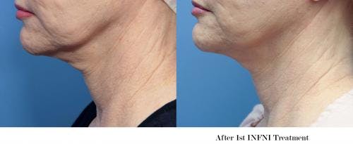 Infini Before & After Gallery - Patient 58214311 - Image 2