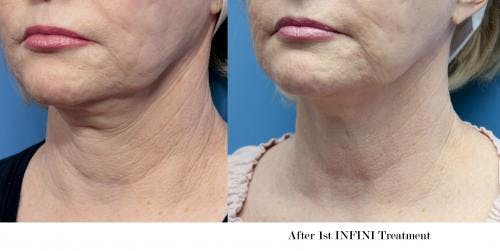 Infini Before & After Gallery - Patient 58214311 - Image 3