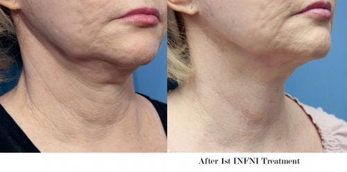 Infini Before & After Gallery - Patient 58214311 - Image 4