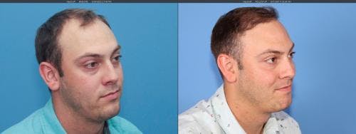 NeoGraft Hair Restoration Before & After Gallery - Patient 58214323 - Image 2
