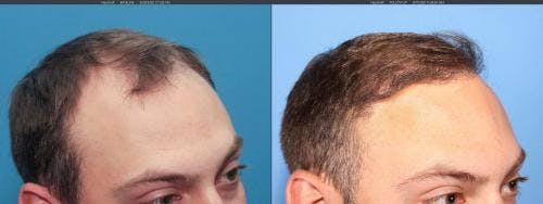 NeoGraft Hair Restoration Before & After Gallery - Patient 58214323 - Image 3
