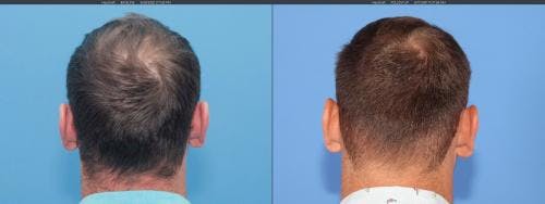 NeoGraft Hair Restoration Before & After Gallery - Patient 58214323 - Image 4