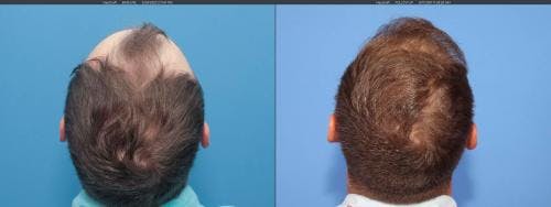 NeoGraft Hair Restoration Before & After Gallery - Patient 58214323 - Image 5