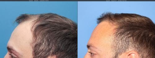 NeoGraft Hair Restoration Before & After Gallery - Patient 58214323 - Image 6