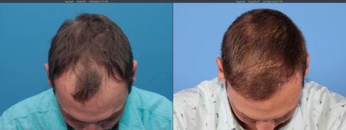 NeoGraft Hair Restoration Before & After Gallery - Patient 58214323 - Image 7