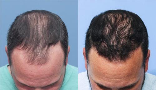 NeoGraft Hair Restoration Before & After Gallery - Patient 58214324 - Image 1