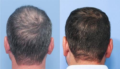 NeoGraft Hair Restoration Before & After Gallery - Patient 58214324 - Image 3