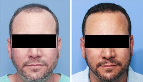 NeoGraft Hair Restoration Before & After Gallery - Patient 58214324 - Image 4