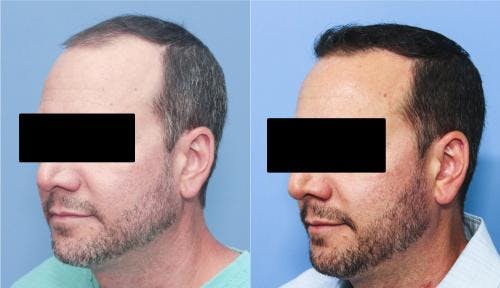 NeoGraft Hair Restoration Before & After Gallery - Patient 58214324 - Image 5