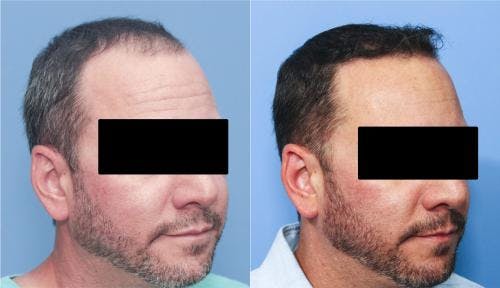 NeoGraft Hair Restoration Before & After Gallery - Patient 58214324 - Image 6