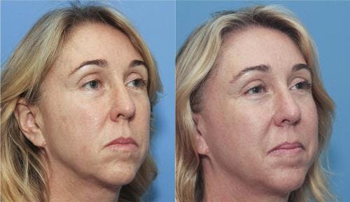 Instalift Before & After Gallery - Patient 58214326 - Image 3