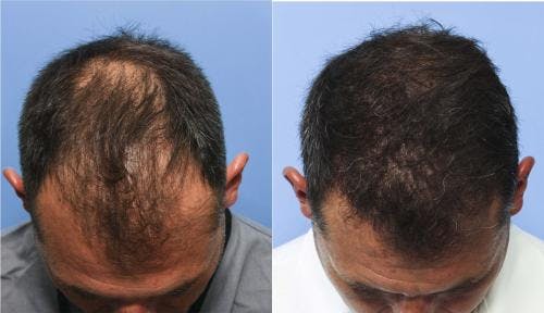 NeoGraft Hair Restoration Before & After Gallery - Patient 58214325 - Image 1