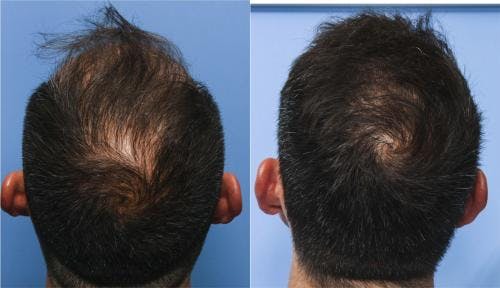 NeoGraft Hair Restoration Before & After Gallery - Patient 58214325 - Image 2