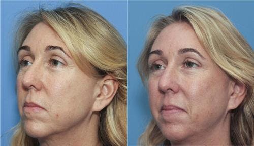Instalift Before & After Gallery - Patient 58214326 - Image 4